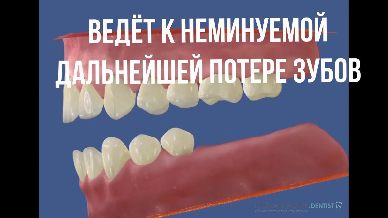 Неполный зубной ряд приводит к дальнейшей потере зубов смотреть онлайн
