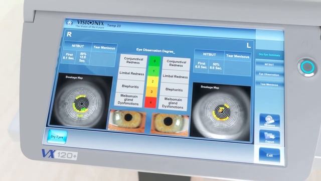 VX-120+ Dry Eye (Segmento anterior y ojo seco) смотреть онлайн