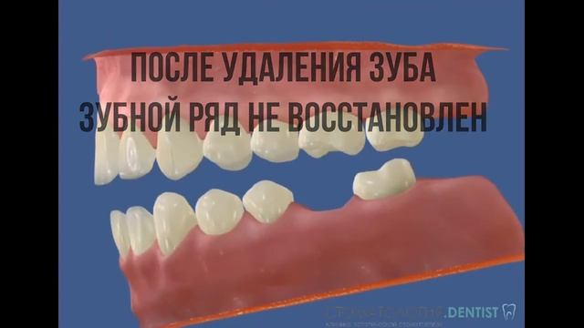 Неполный зубной ряд неминуемо ведет к изменению прикуса и дальнейшей потере зубов. смотреть онлайн