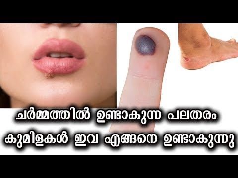 Different types of skin lesions / ചർമ്മത്തിൽ ഉണ്ടാകുന്ന പലതരം കുമിളകൾ / Tips N Tricks смотреть онлайн