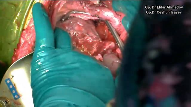 Living Donor Liver Transplantation Recipient procedure смотреть онлайн