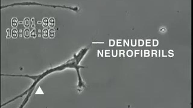 How Mercury Causes Brain Neuron Degeneration смотреть онлайн
