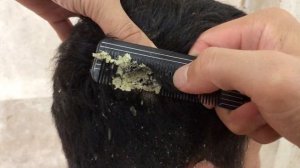 itchy scratching ||  dandruff removal off big flakes  || ASMR Scratching #189