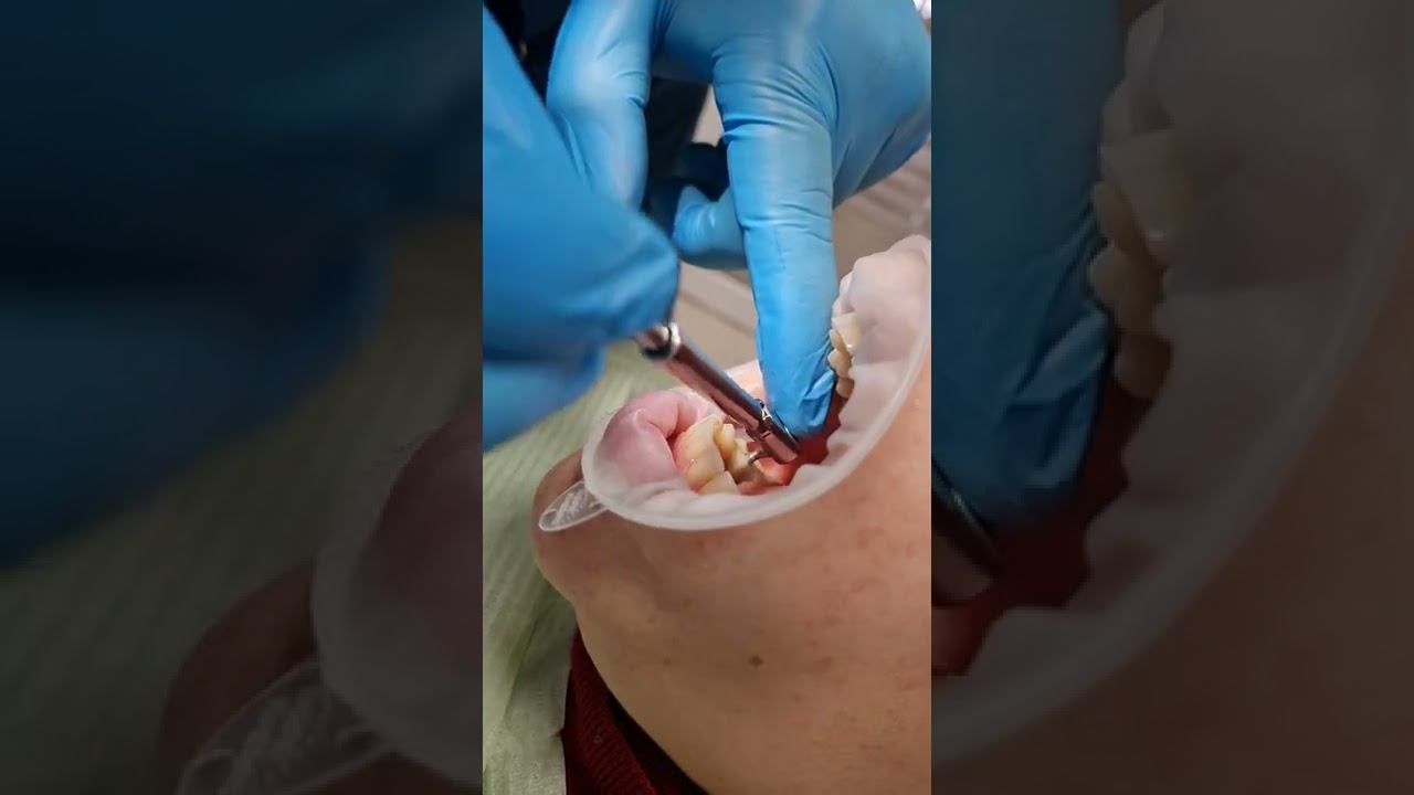 Доктор стоматологии "Дент-Реал" Краснодар фиксирует имплант смотреть онлайн