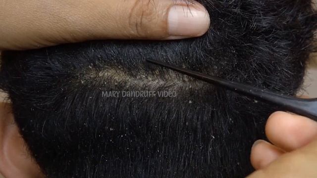 Removing Dry Itchy Scalp And Big Flakes On Back Side #403 смотреть онлайн