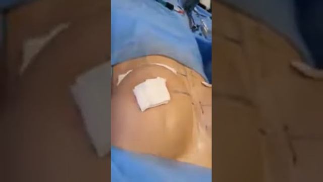 Збільшення грудей. Мамопластика. смотреть онлайн
