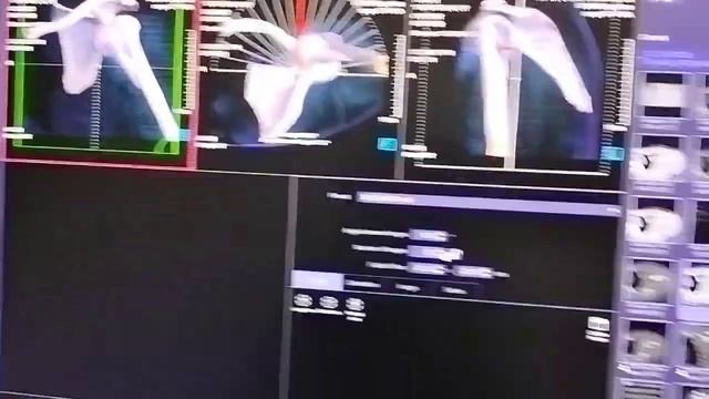 siemens 32 Slice 3D shoulder joint film kese de смотреть онлайн