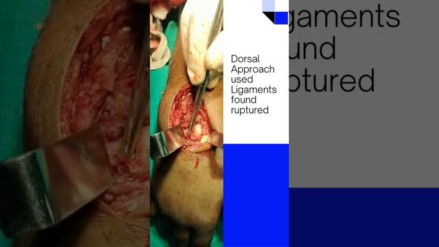 Perilunate Dislocation Surgery #complextrauma #fracture #orthopedicsurgeons #dranuragmittal смотреть онлайн