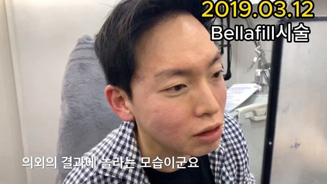 엘란쎄와 흉터필러 시술 후 4년 뒤의 모습 смотреть онлайн