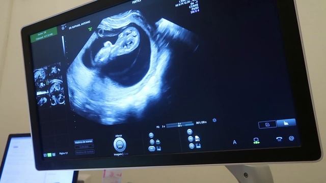 FIZ O TERCEIRO ULTRASSOM E JÁ DEU PRA VER O SEXO DO BEBE?! смотреть онлайн