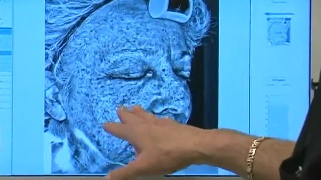 MiXto CO2 Fractional Laser Skin Care Laser Treatment смотреть онлайн