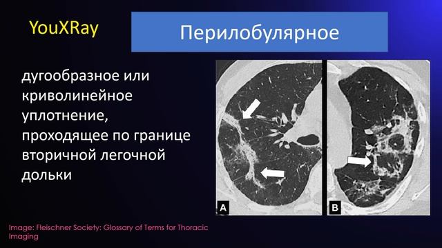 Глоссарий Флейшнеровского общества 2024 - Часть 2 Анатомическое распределение смотреть онлайн