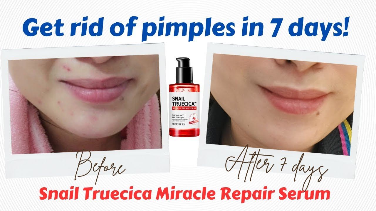 HONEST REVIEW! Snail Truecica Miracle Repair Serum | HOW TO GET RID OF PIMPLES IN 7 DAYS! смотреть онлайн