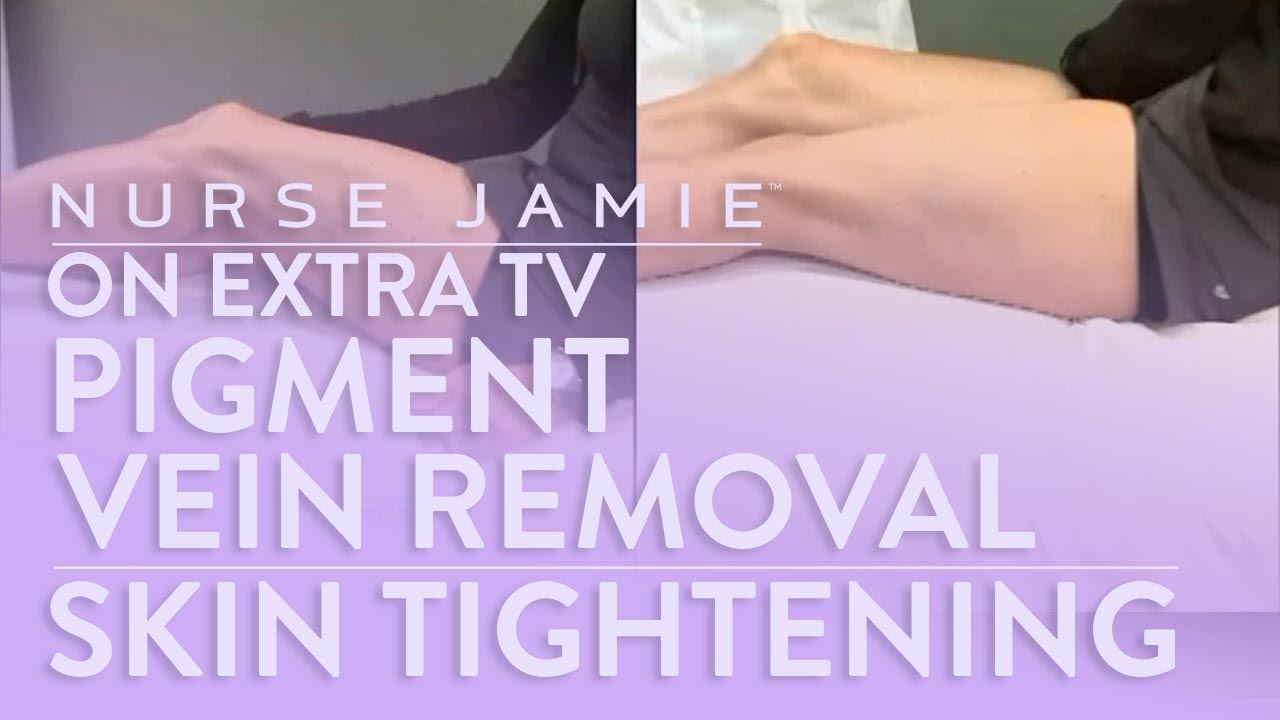 Skin Tightening & Pigment, Vein Removal - Nurse Jamie on Extra TV смотреть онлайн