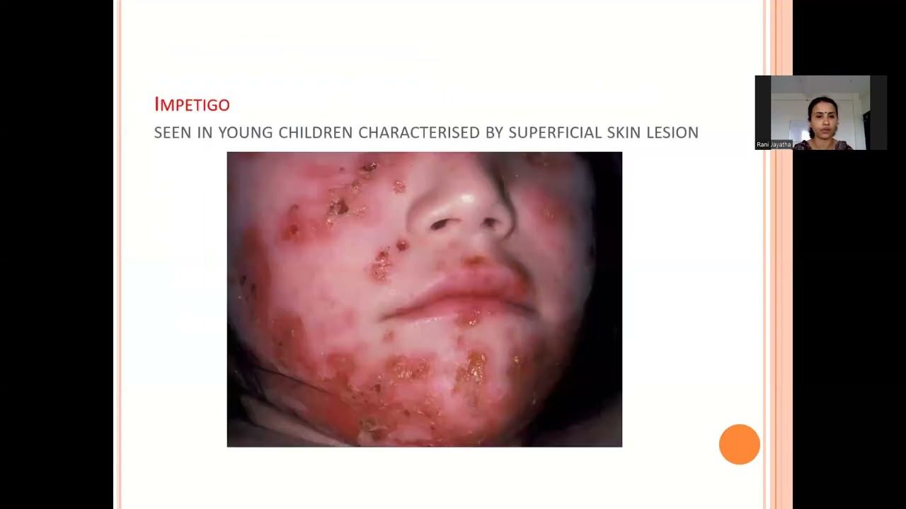 STREPTOCOCCUS PYOGENES BY DR. ANJALI | DEPT. OF MICROBIOLOGY смотреть онлайн