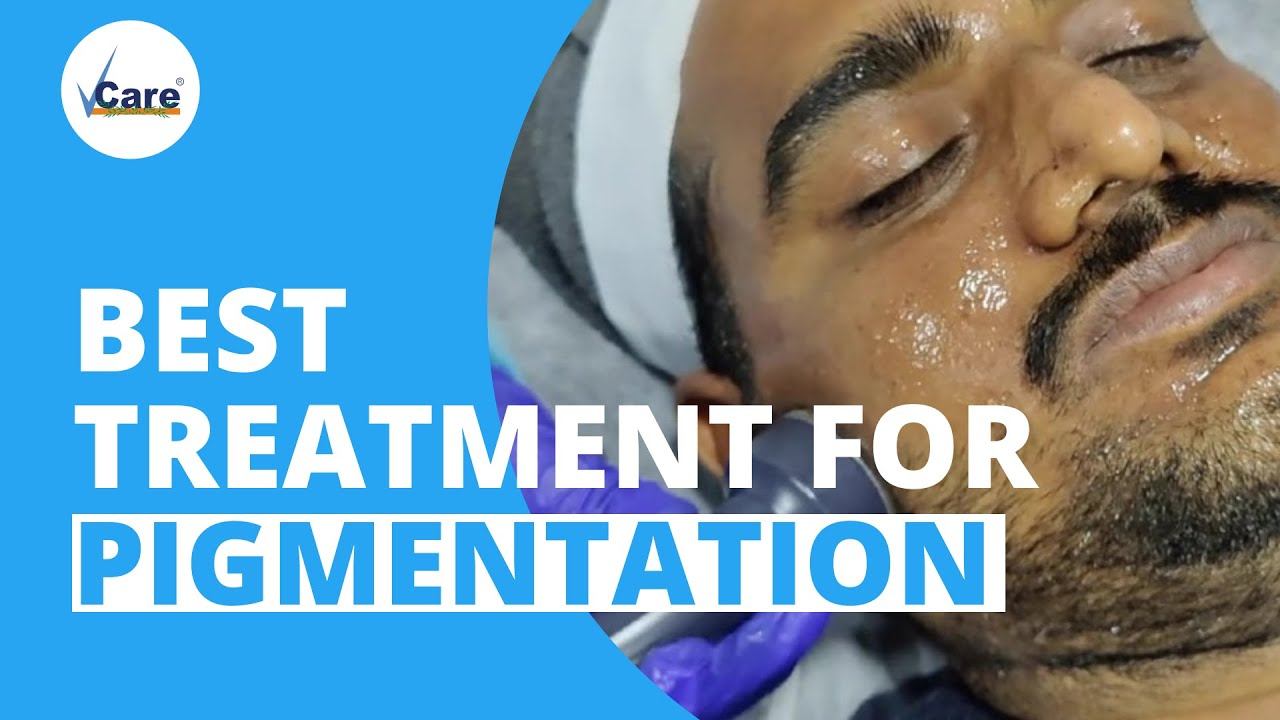 Best Treatment For Pigmentation | Melanin Break Therapy | VCare смотреть онлайн