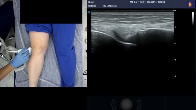 УЗИ коленного сустава смотреть онлайн
