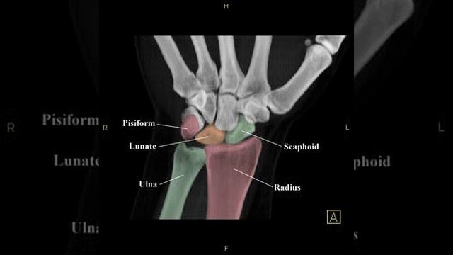 Wrist Anatomy: 3D Corrolation Anterior View смотреть онлайн