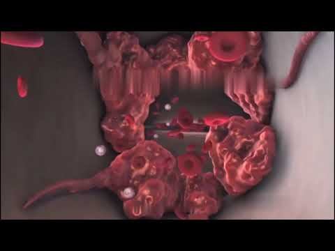 Патологофизиологические аспекты тромбообразования смотреть онлайн