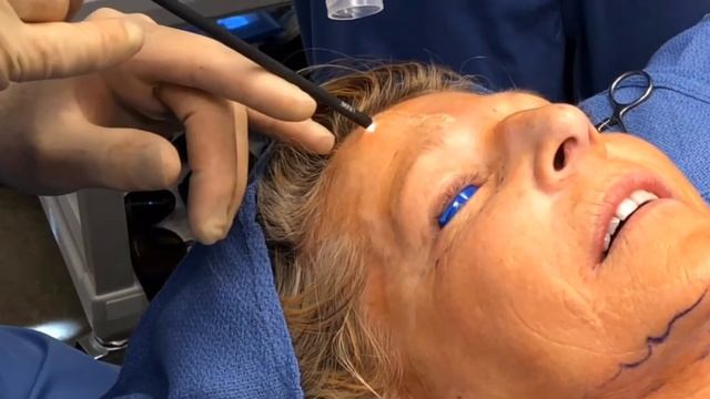 Renuvion (J-Plasma) Procedures - Denver, CO Plastic Surgery смотреть онлайн