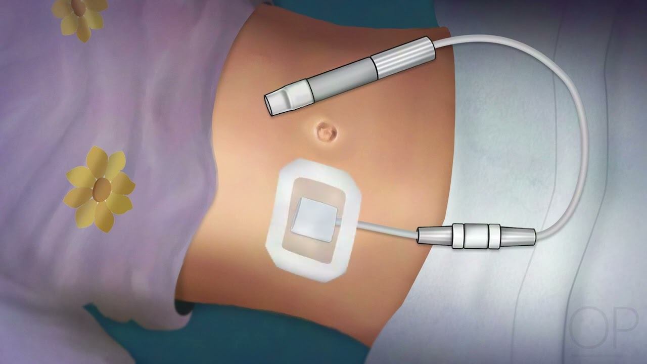 Peritoneal Dialysis Catheter смотреть онлайн