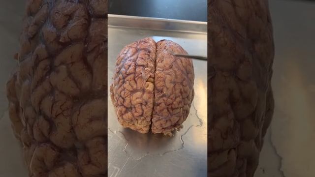 This Separates the Brain Hemispheres смотреть онлайн