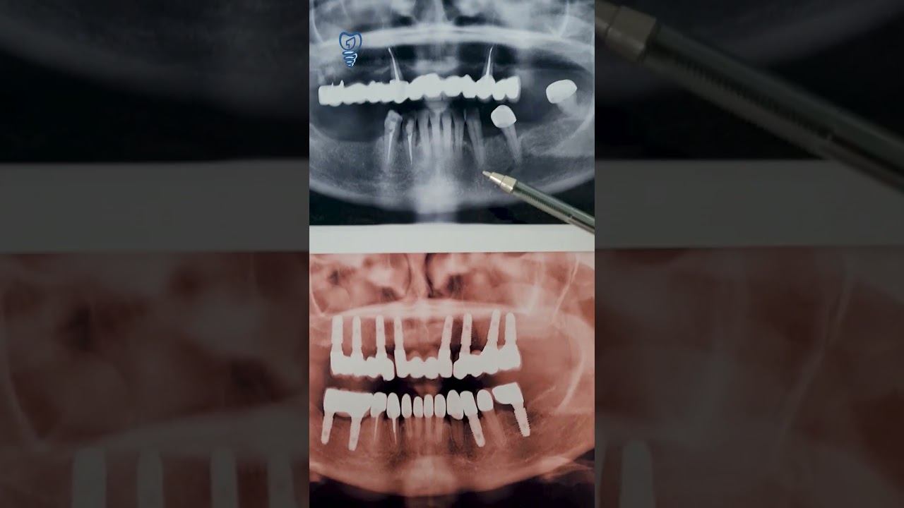 Очередной счастливый пациент. Сохранили свои зубы. Имплантация зубов. смотреть онлайн