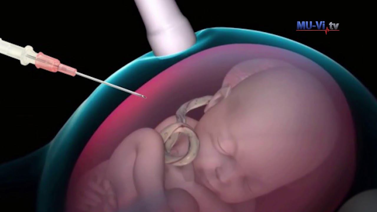 Possibilities for non-invasive prenatal diagnosis смотреть онлайн
