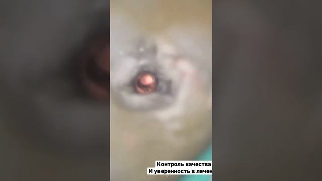 Пломбировка каналов зуба , эндо лечение зубов , виниры , стоматология , Сурайкин Илья смотреть онлайн
