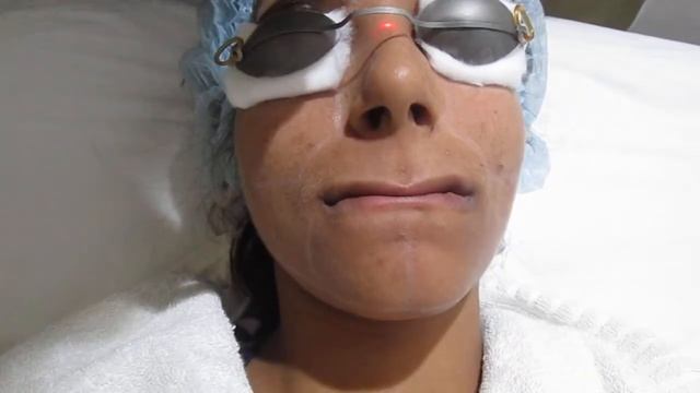 Freckles Removal by Q Switched Laser in Delhi ! Best Dermatologist in Delhi смотреть онлайн