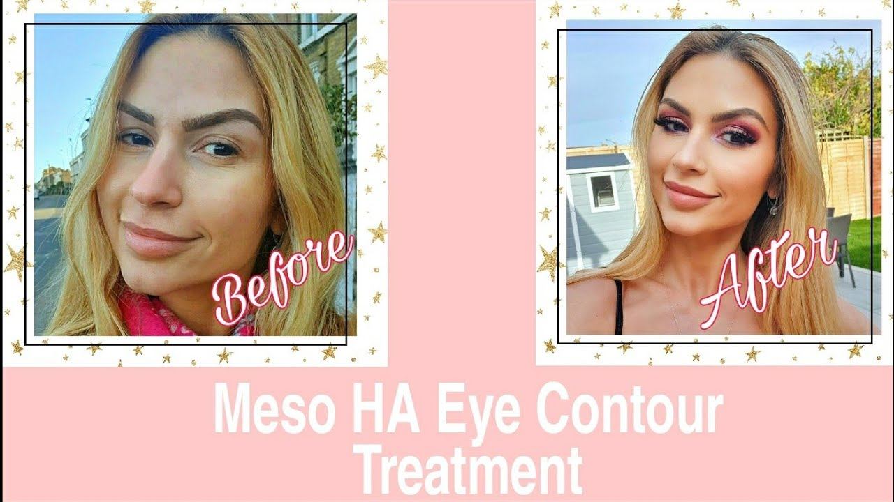 Meso HA Eye Contour #darkcirclestreatment #tiredeyes смотреть онлайн