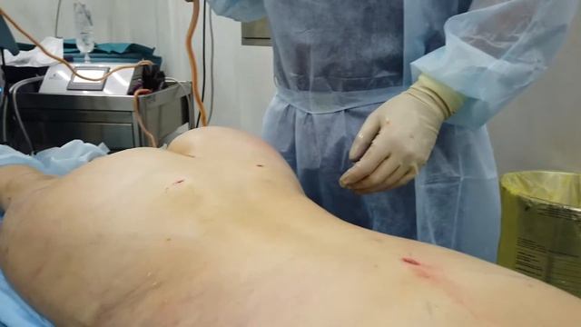 ЛИПОМОДЕЛИРОВАНИЕ – ИСТОРИЯ ПАЦИЕНТКИ смотреть онлайн