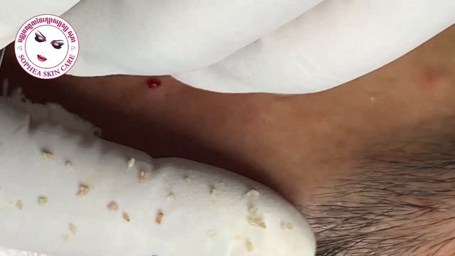 Acne’s facial removal treatment by Sophea Skin Care Cambodia 24 June 2023 смотреть онлайн