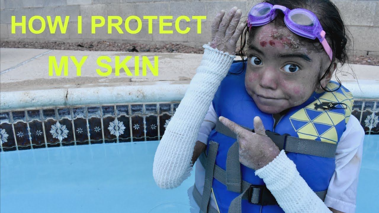 WHAT'S UNDER MY BANDAGES | EPIDERMOLYSIS BULLOSA смотреть онлайн