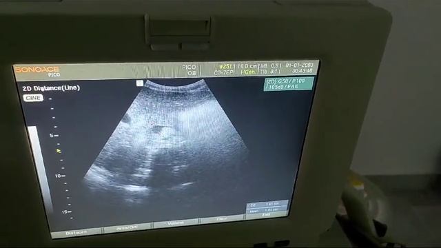 Анатомия от Стивена. УЗИ брюшной полости: сегменты и размеры брюшной полости. смотреть онлайн