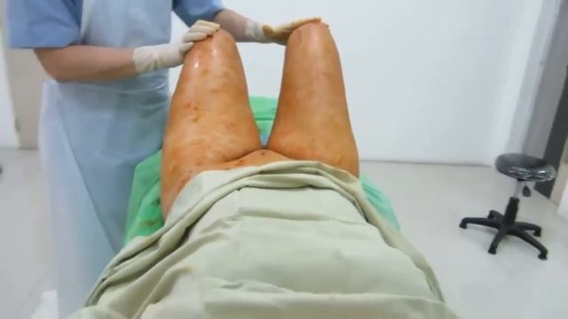 СЛУЧАЙ № 34, ВИДЕО 1 ЛИПОСАКЦИЯ ОГРОМНЫХ БЕДЕР! смотреть онлайн