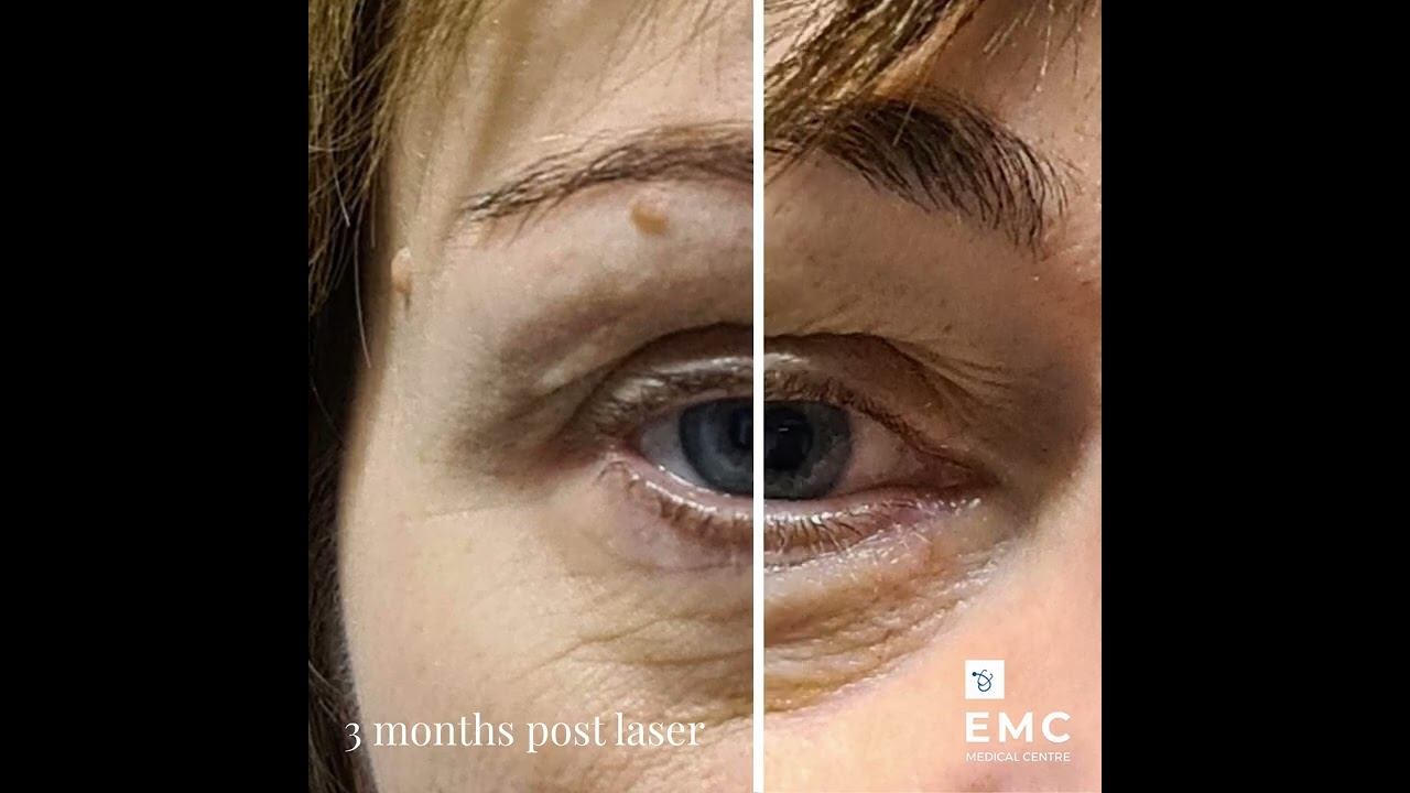 Smooth eye laser смотреть онлайн