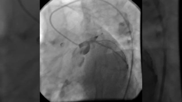 Селективная КГ левой коронарной артерии смотреть онлайн