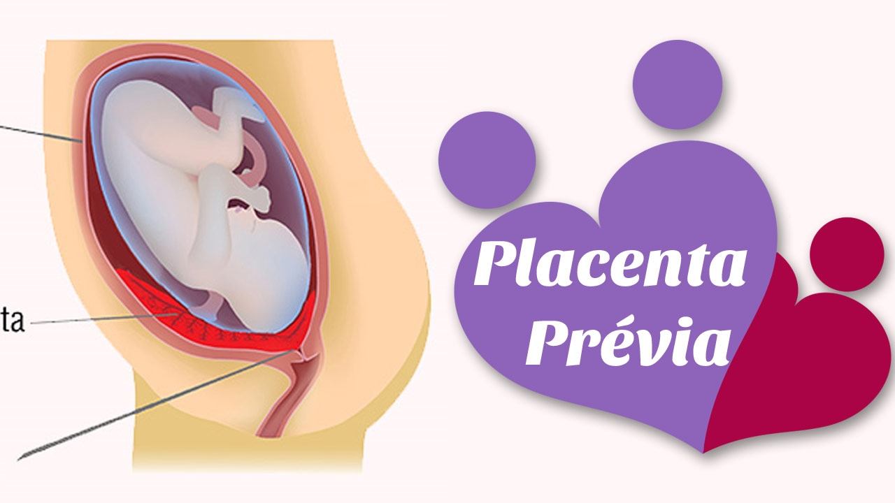 Placenta prévia смотреть онлайн