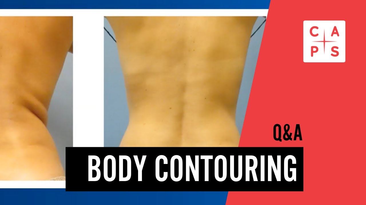 Body Contouring Q&A at CAPS: CoolSculpting Elite, EmSculpt and more! смотреть онлайн