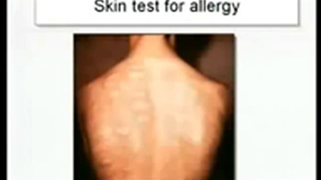 1.25. Hypersensitivity States I and II - Immunology Video Lectures смотреть онлайн