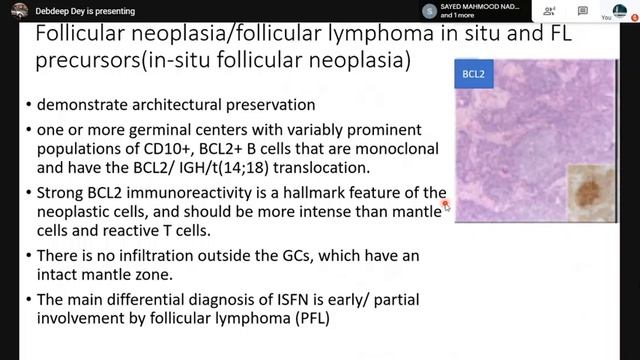 Pursue 2B (Uploaded): Spectrum of Low Grade B Cell NHL смотреть онлайн