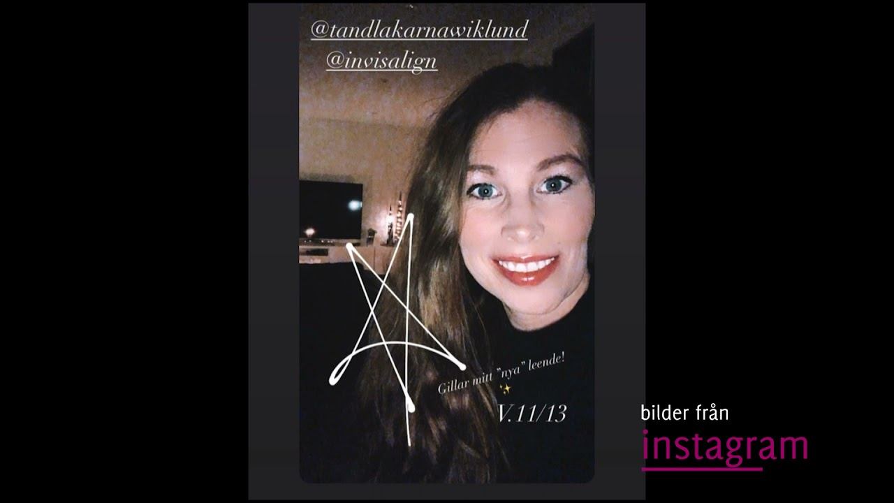 Invisalign del 4- genom instagram смотреть онлайн