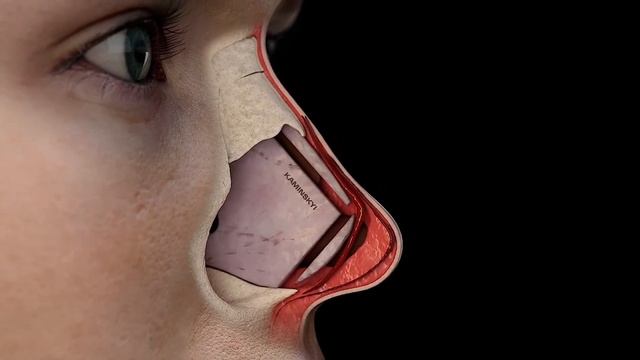 PRESERVATION PUSH DOWN RHINOPLASTY BY CLOSED TECHNIQUE / KAMINSKYI смотреть онлайн