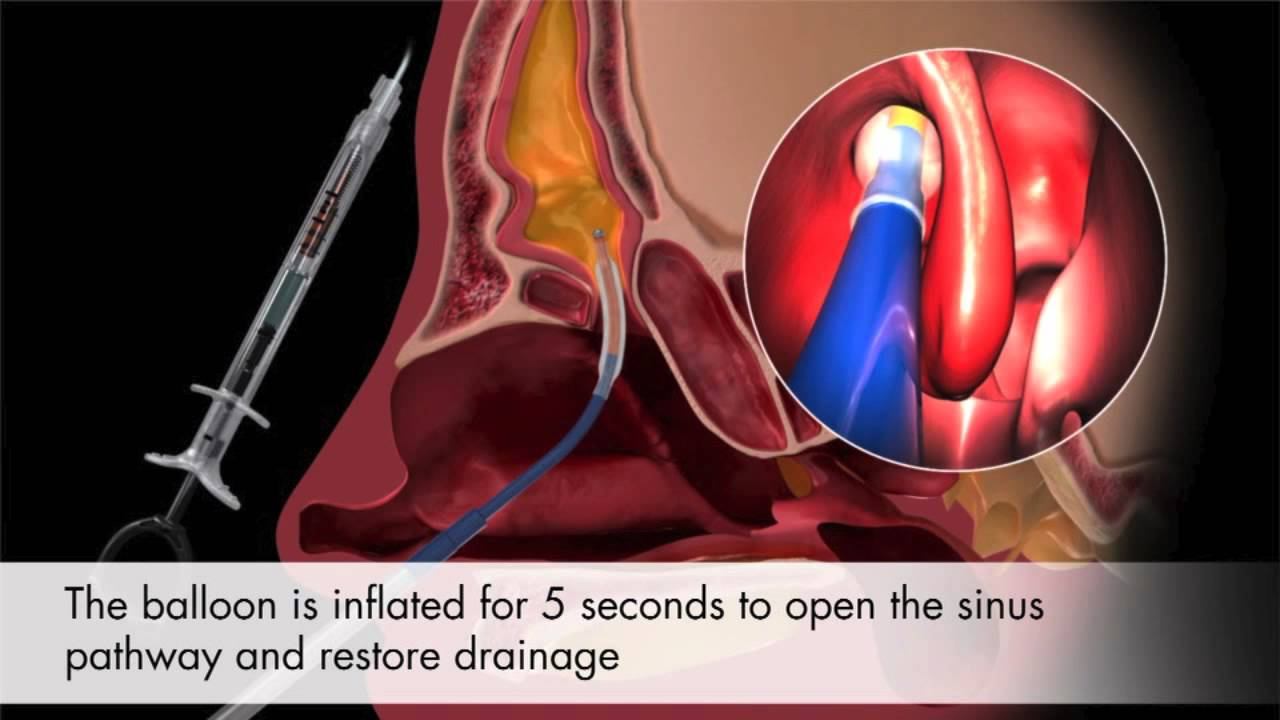 Balloon Sinuplasty Animation & Patient Testimonials - Houston Sinus Center смотреть онлайн