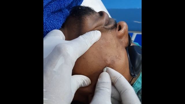 acne scar treatment | best acne scar removal | rejuve derma clinic | contact 9700020802 смотреть онлайн
