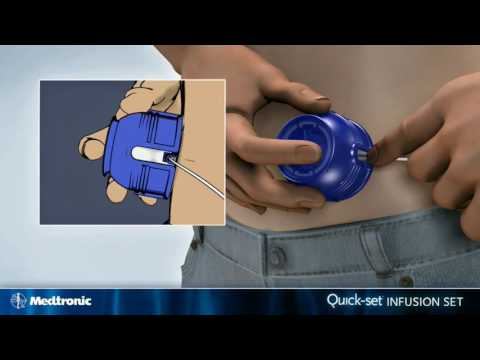 Medtronic Infusion system Quick-Set смотреть онлайн