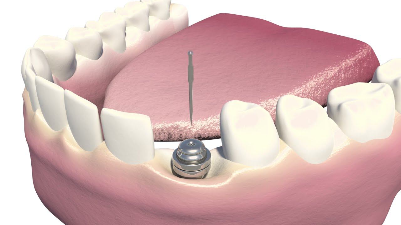 What is a dental implant? | Bionica Dental Wellness смотреть онлайн