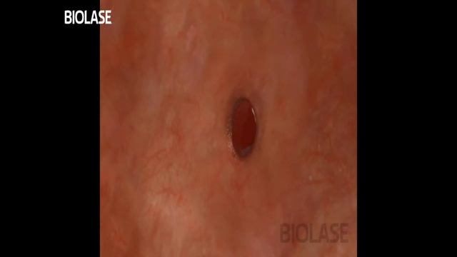 Biopsy Laser смотреть онлайн