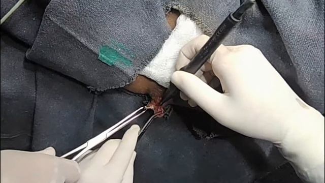 ANAL SKIN TAGS EXCISION смотреть онлайн